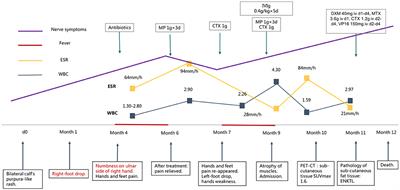 Case report: Mononeuropathy multiplex of extranodal natural killer/T-cell lymphoma misdiagnosed as systemic vasculitis